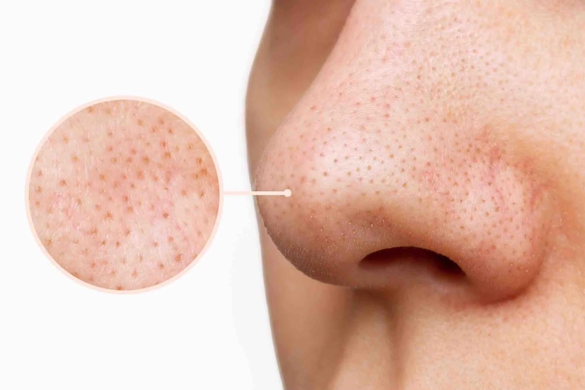 Clogged Pores Treatments in Richmond Hill