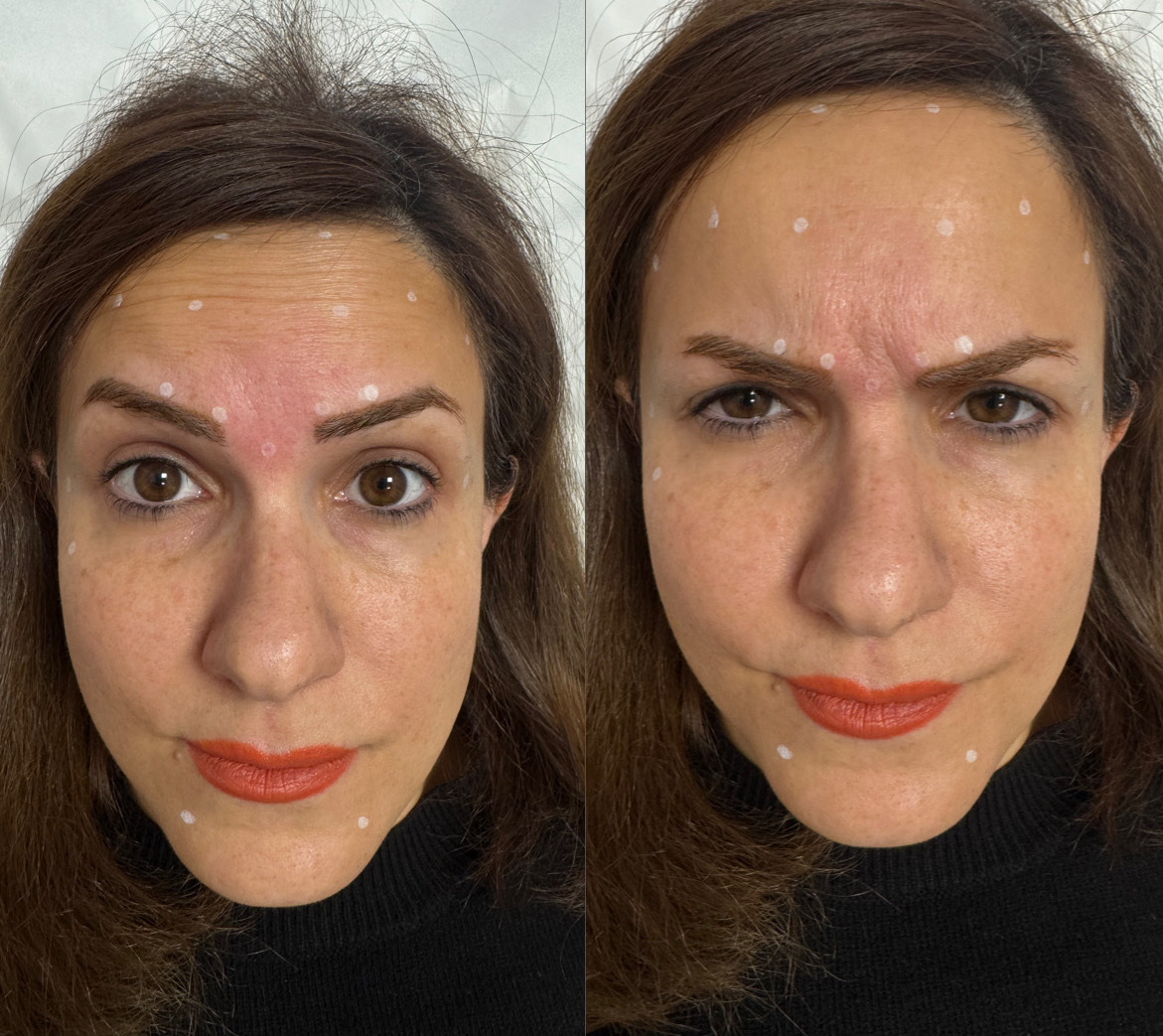 before: Botox for Brow Lift
