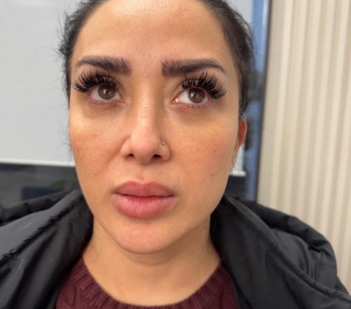 after: Botox for Forehead Lines
