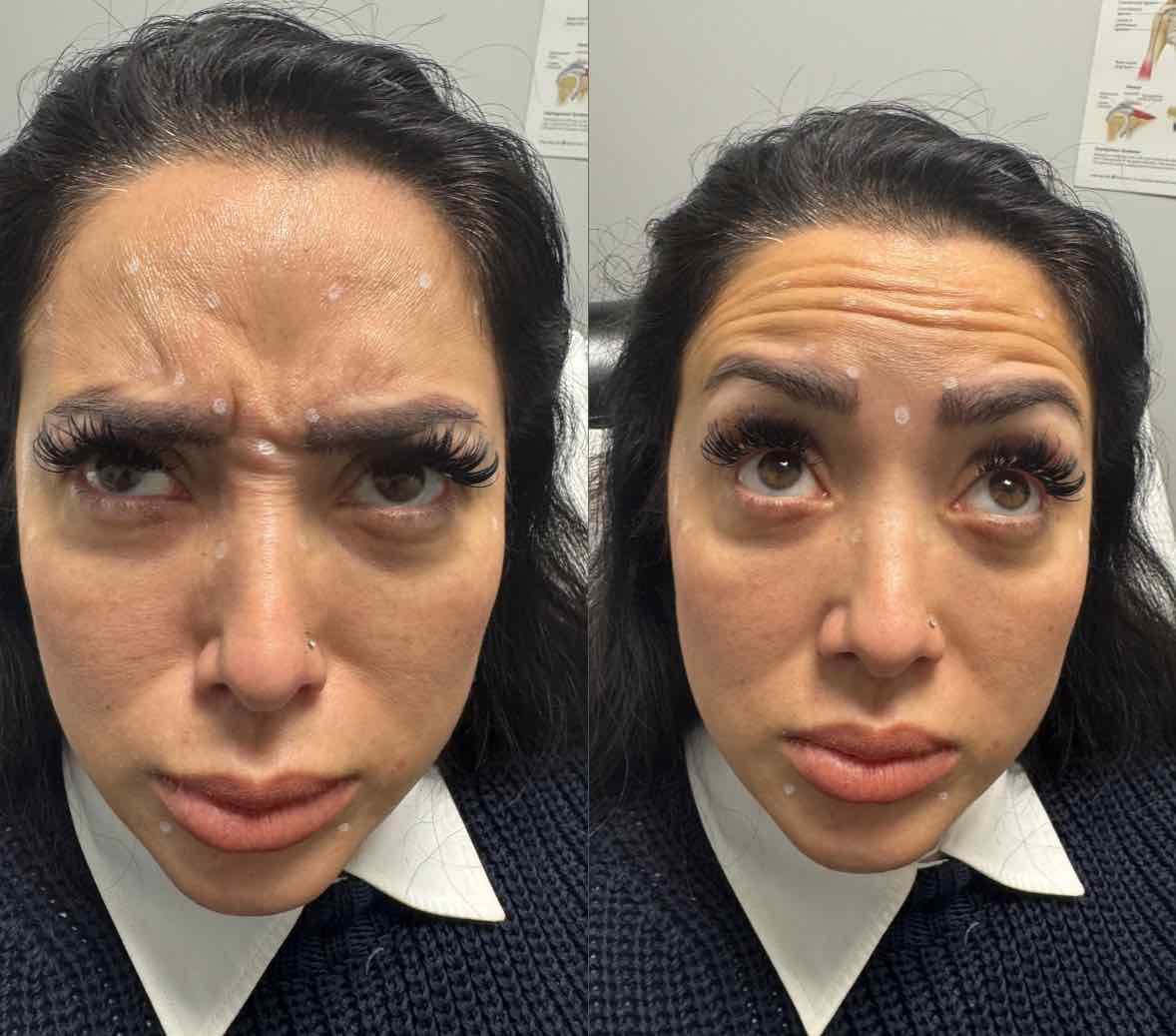 before: Botox for Forehead Lines